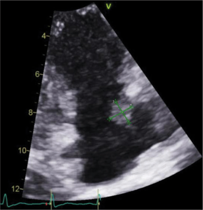 A 47-year-old male who presented in septic shock with bacteremia and was found to have infective endocarditis with a right atrial septal vegetation. Transthoracic echocardiographic guidance during the thrombectomy procedure showed the right atrial septal vegetation, which measured 3 × 1.7 cm. The green markers indicate the measurement of the vegetation.