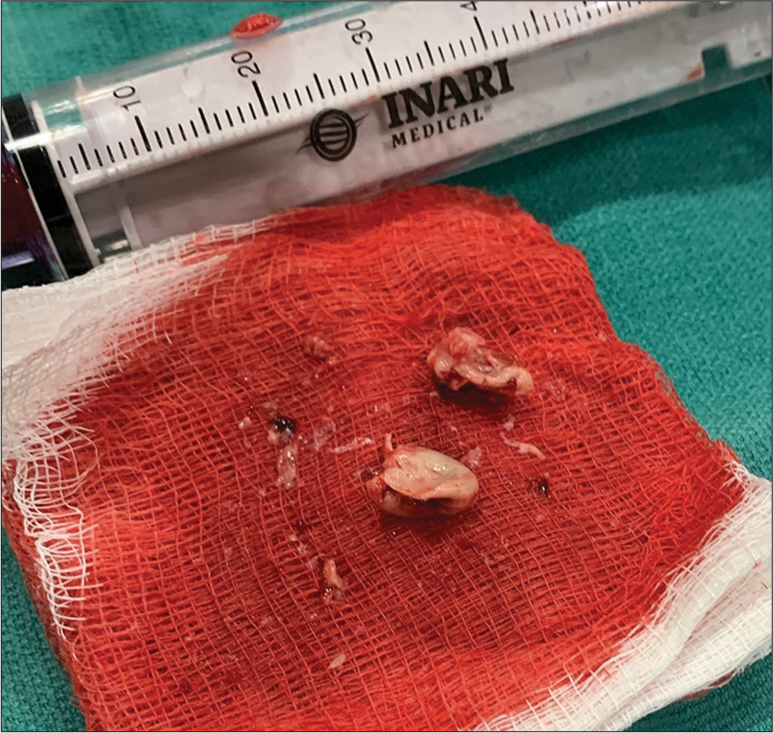 A 47-year-old male who presented in septic shock with bacteremia and was found to have infective endocarditis with a right atrial septal vegetation. Photograph shows the two fragments that comprised the right atrial septal vegetation that was removed through vacuum-assisted thrombectomy.