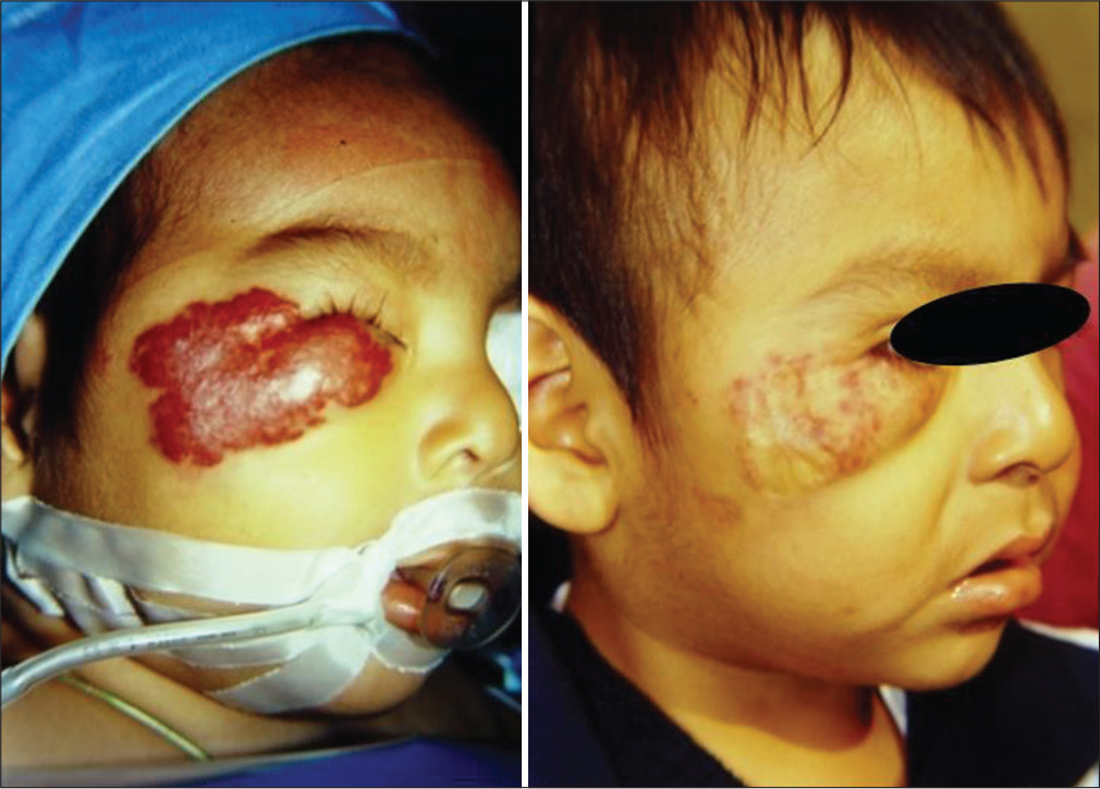Case 3 — Pre- and 6 months’ post-embolization of a 14 months old male with a superficial hemangioma of the right malar region and lower eyelid that caused palpebral closure with potential amblyopia. One month after transarterial embolization, the eye aperture was freed. Clinical picture 6 months later showed conspicuous tumor regression. The patient was sent to plastic surgery to consider skin grafting.