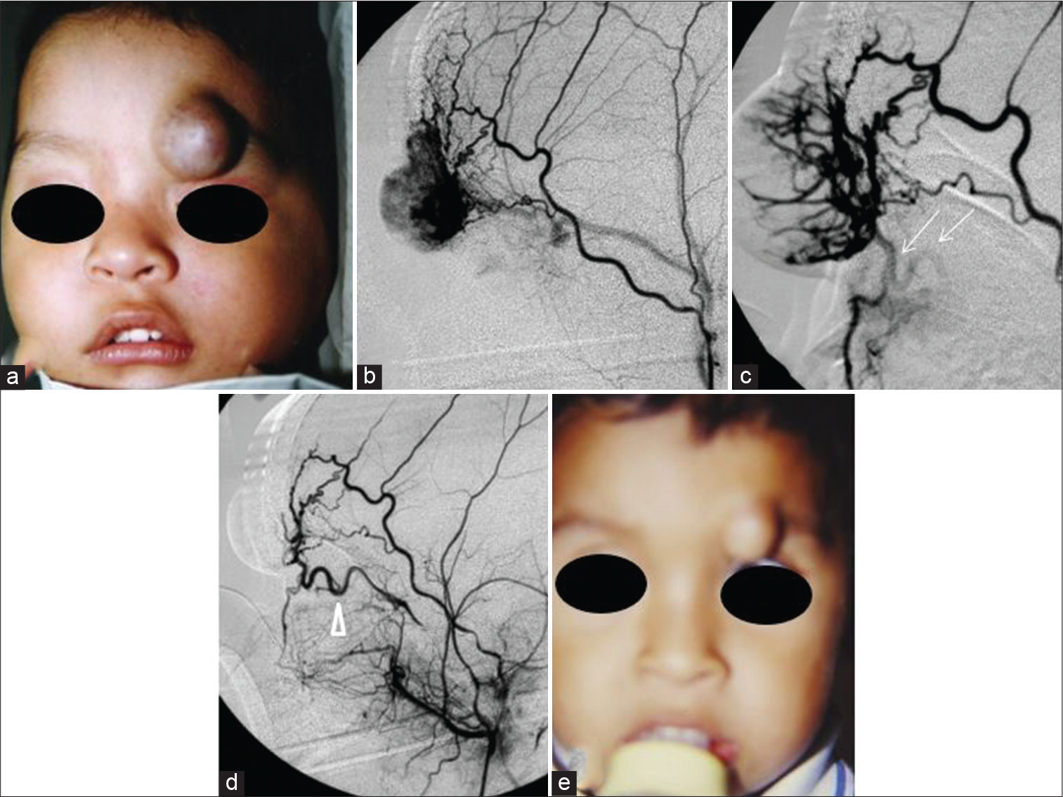 Case 4 — (a) A 1-year-old male with a rapidly growing left eyebrow infantile hemangiomas before transarterial embolization (TAE). (b) Profuse hypervascularization mainly supplied by the orbitary branch of the superficial temporal artery. (c) A tortuous anastomotic vessel was faintly seen in the final stage of the embolization (thin arrows). (d) Post-TAE angiogram showed a tortuous ophthalmic artery that supplied the tumor as well (arrowhead). It was safely embolized without compromising the central artery of the retina using gentle injections of PVA particles through the orbitary branch of the external carotid artery. (e) Five months after TAE, the tumor was converted to a hypovascularized and fibrofatty lump. The patient was sent to plastic surgery for excision.