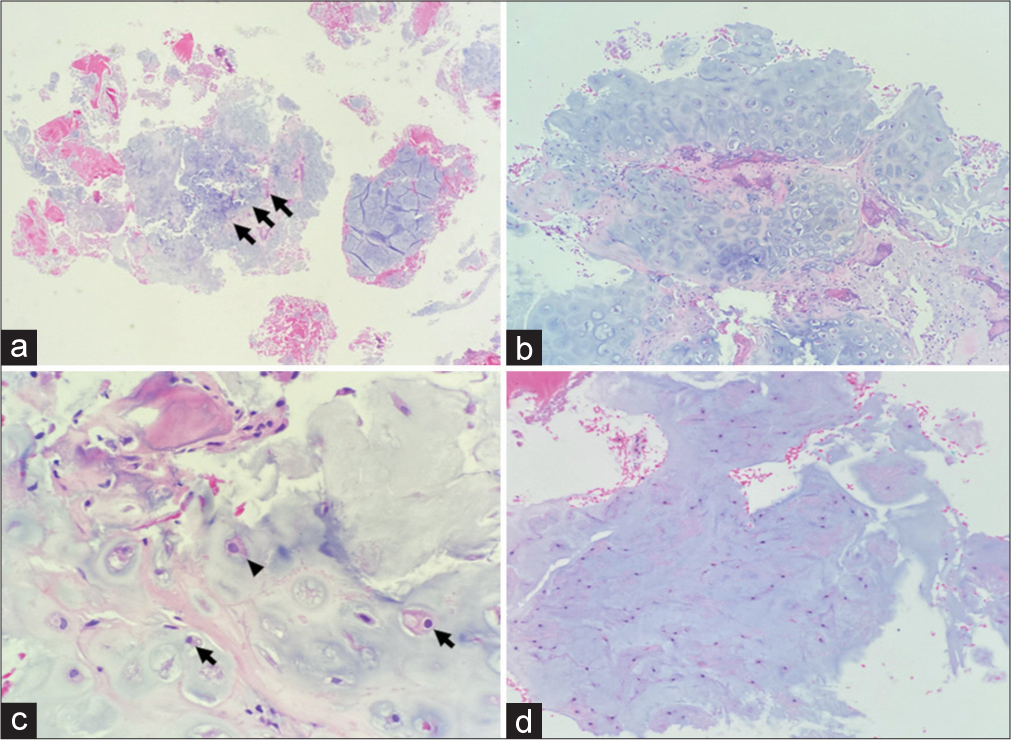 Image-guided needle biopsy of cartilage tumor in the posterior left acetabulum, stained with hematoxylin and eosin. (a) ×2: Fragments of bone, hyaline cartilage, and small foci of myxoid changes. The hyaline cartilage displays focally moderate cellularity (arrows). (b) ×4: Higher power view of the area of moderate cellularity in the hyaline cartilage: The neoplastic cells reside in the lacunar spaces. (c) ×50: The hyaline cartilage exhibits mild focal cytologic atypia. The majority of chondrocytes have small, round, dark nuclei, and lack nucleoli (arrows). A few cells show atypia, with fine chromatin and small nucleoli (arrowhead). (d) ×20: Higher power view of myxoid cartilage. The chondrocytes in this area are spindled and reside in the basophilic extracellular matrix, not in lacunar spaces.