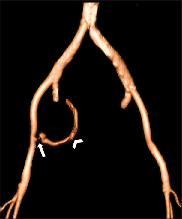 A 68-year-old woman with radiation-induced pelvic arterioenteric fistula presented with massive melena, hematochezia, and hematemesis. Three-dimensional volume rendering techniques of the contrast-enhanced CT angiogram with bone removal demonstrate active contrast extravasation from the medial wall of the right external iliac artery (arrow) with curvilinear streak (arrowhead) corresponding to the contrast outlining the wall of an adjacent loop of the small bowel.