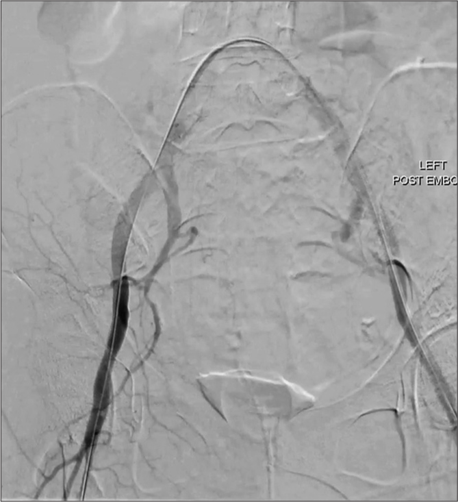 A 68-year-old woman with radiation-induced pelvic arterioenteric fistula presented with massive melena, hematochezia, and hematemesis. Digital subtraction angiography post-stenting angiogram cine images demonstrate cessation of contrast extravasation from the right external iliac artery.
