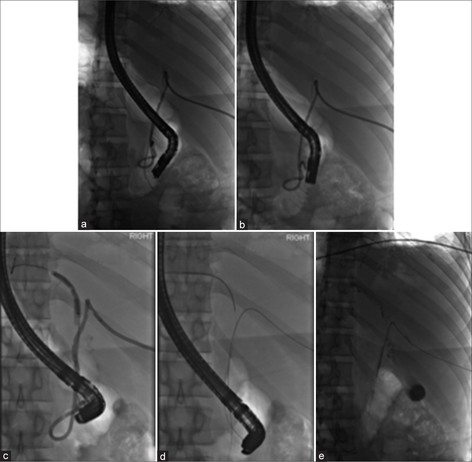 A 32-year-old male who presented with fever and abdominal pain and was found to have acute cholangitis 2 days following ERCP and left hepatic biliary stent placement. (a) Radiograph shows the distal portion of the fractured biliary stent in the CBD, while the proximal portion is seen in the LHD at time of ERC. (b) Radiograph shows the proximal portion of the fractured biliary stent in the LHD after the distal end was removed using a stent grabbing forceps. (c) Radiograph shows retrieval of the proximally migrated stent fragment with a 4 mm dilating balloon. (d) Radiograph shows successful removal of the fractured stent with the left- and right-sided wires in place. (e) Fluoroscopic image at completion of the procedure with percutaneous wire in place. ERCP: Endoscopic retrograde cholangiopancreatography, LHD: Left hepatic duct, CBD: Common bile duct.