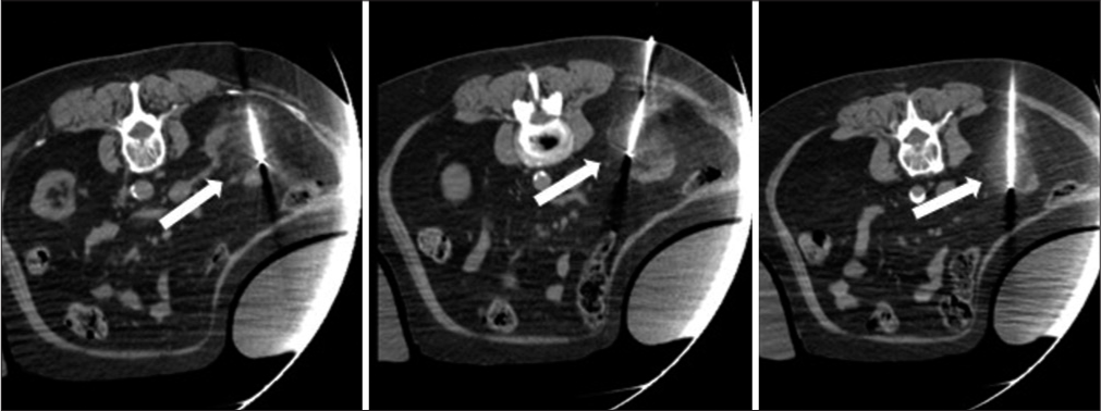 An 82-year-old female who presented for cryoablation of a T1a clear cell adenocarcinoma of the right kidney. Axial CT images during cryoablation demonstrating 3 Ice Force cryoablation needles in the lesion with good ice coverage around the lesion (arrows).