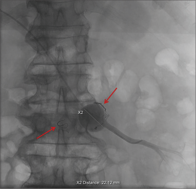 An 87-year-old male who presented with bloody bowel movements diagnosed with superior mesenteric vein (SMV) aneurysm. Percutaneous transhepatic venogram through a 5 Fr catheter shows a 2.2 cm venous aneurysm arising from a medial branch of the SMV. Please note previously embolized arteries going toward the venous aneurysm using coils (red arrows).