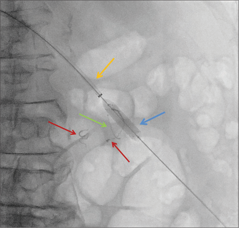 An 87-year-old male who presented with bloody bowel movements diagnosed with superior mesenteric vein aneurysm. Configuration of stent-assisted coil embolization of the venous aneurysm. A 6 mm × 37 mm balloon expandable stent (blue arrow) is deployed over the area of venous aneurysm through a 6 Fr sheath (yellow arrow). Please note that before deployment of the balloon expandable stent an angled 2.4 Fr microcatheter is placed within the aneurysm sac (green arrow). Red arrows demonstrate previous arterial coils.