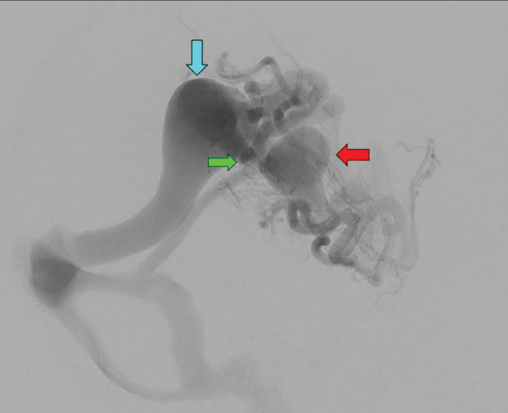 A 5-year-old female presented with headaches found to have two direct arteriovenous fistulas along the right temporal parietal lobe. Digital subtraction angiogram showing two direct arteriovenous fistulas in the right temporal parietal lobe. The more anterior lesion has a 2 × 2 cm venous pouch (red arrow), supplied by dilated temporal branches of the right middle cerebral artery (MCA) and right posterior cerebral artery (PCA). This lesion has a unique draining vein but is also connected to the venous pouch of the more posterior lesion (green arrow). The more posterior lesion has a 3.5 × 2.5 cm venous pouch (blue arrow), supplied by dilated parietal branches of the right MCA and right PCA.
