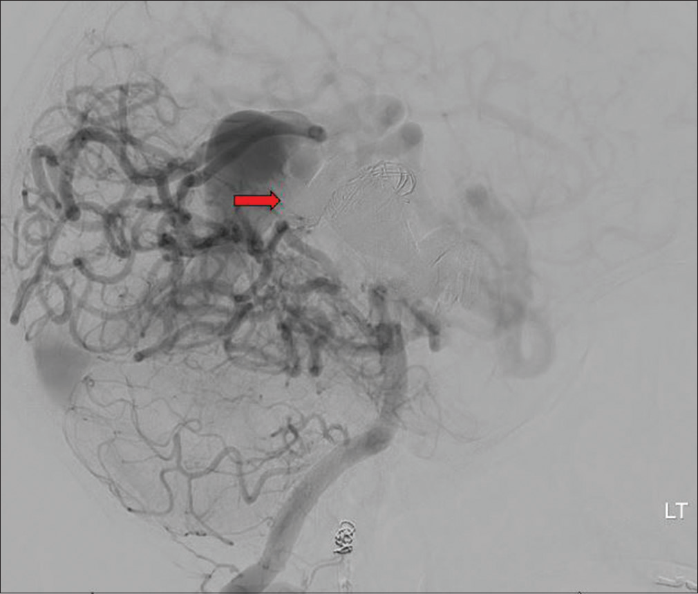 A 5-year-old female presented with headaches found to have two direct arteriovenous fistulas along the right temporal parietal lobe. Digital subtraction angiogram showing successful balloon-assisted Onyx embolization of the largest feeding artery to the right parietal arteriovenous malformation (red arrow) with marked reduction of stealing phenomenon and better flow to the right middle cerebral artery cortical branches.