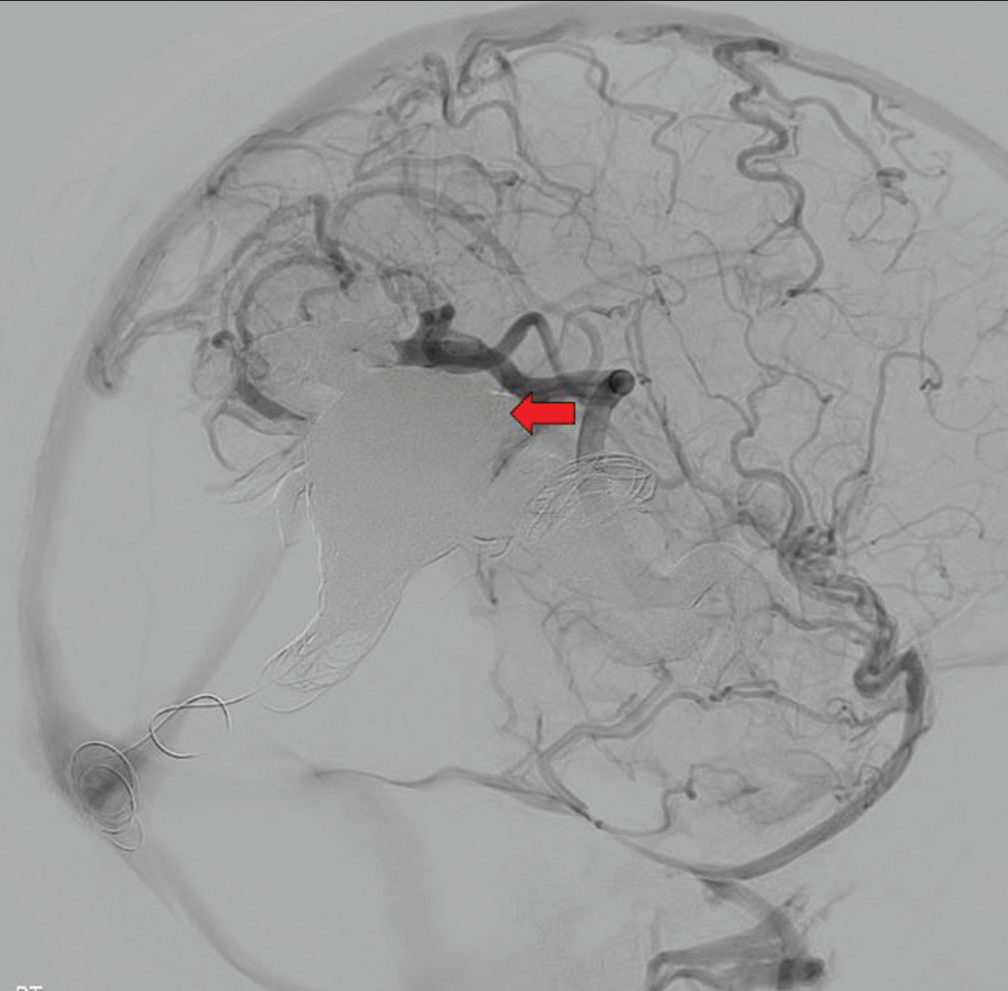 A 5-year-old female presented with headaches found to have two direct arteriovenous (AV) fistulas along the right temporal parietal lobe. Digital subtraction angiogram showing successful transvenous and transarterial embolization of right temporal arteriovenous fistula with complete obliteration of AV shunting (red arrow) and improved cortical flow to the right middle cerebral artery territory.