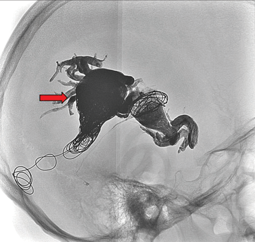 A 5-year-old female presented with headaches found to have two direct arteriovenous (AV) fistulas along the right temporal parietal lobe. Digital subtraction angiogram showing successful transvenous and transarterial embolization of the right temporal arteriovenous fistula with complete obliteration of AV shunting and improved cortical flow to the right middle cerebral artery territory (image of complete staged occlusion – red arrow).