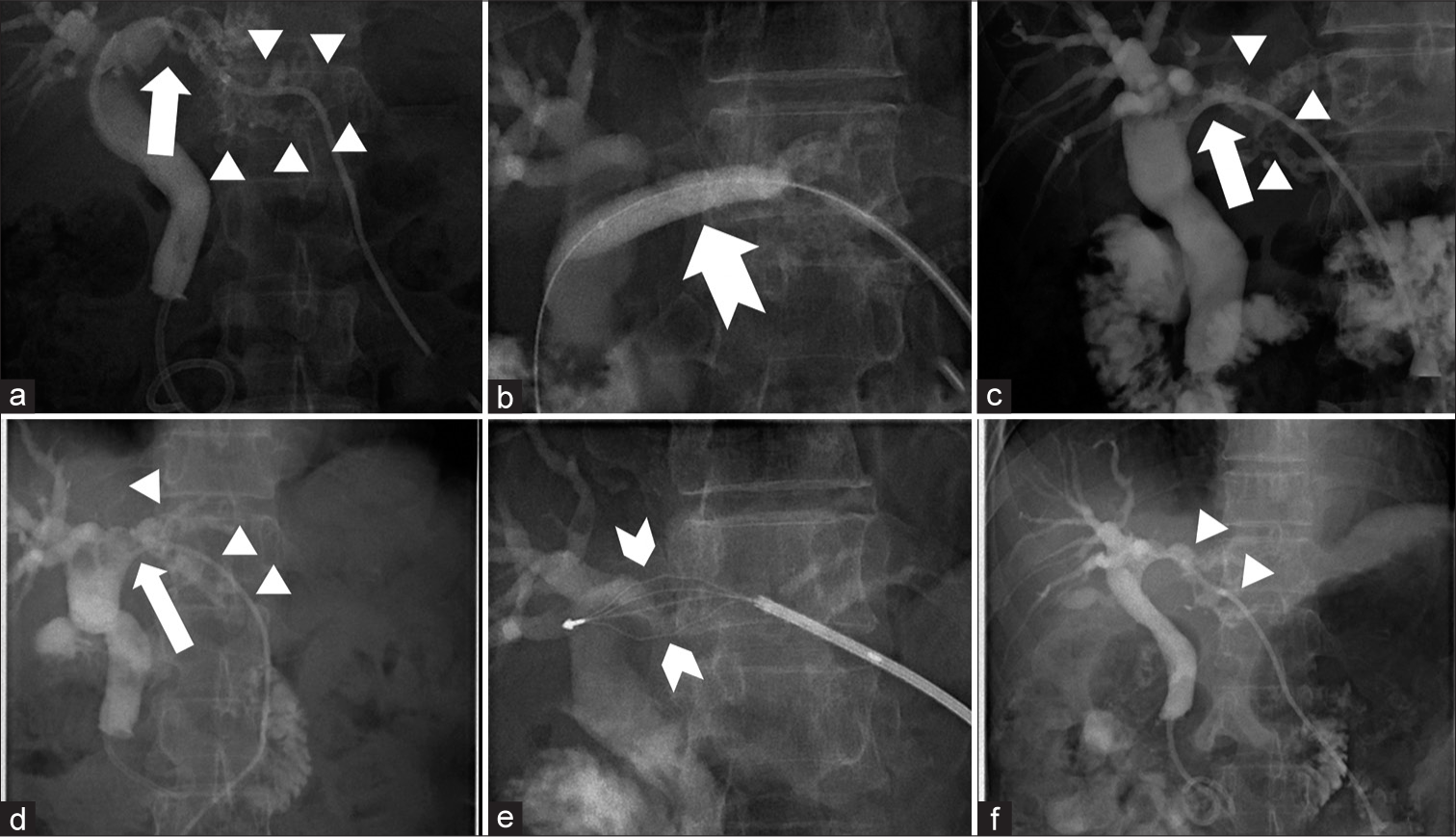 A 50-year-old female with known RPC presented with fever. Fluoroscopic images from the first (a-c) and staged second trials (d-f). (a) Percutaneous transhepatic biliary drainage (PTBD) cholangiogram showed a left intrahepatic duct (IHD) stricture (arrow) and innumerable small ductal stones (arrowheads). (b) Application of 10 × 40 mm Mustang balloon (notched arrow) to the left IHD stricture, followed by repeated balloon occlusion technique to expel stones into the duodenum (not shown) (c) Check angiogram showed improvement of the stricture (arrow) and less residual ductal stones (arrowheads). (d) PTBD cholangiogram showed persistent left IHD stricture (arrow) and multiple small ductal stones (arrowheads). (e) LithoCrushV device (notched arrowheads) captured and crushed the ductal stones. (f) Check cholangiogram showed less residual ductal stones (arrowheads). No filling defects in the common duct.