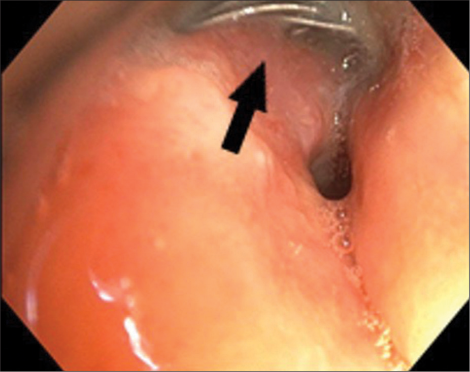 Endoscopic view of coil in the right main bronchus (black arrow).