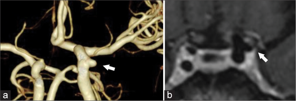 A 74-year-old woman with a left pupil-sparing oculomotor palsy. (a) Computed tomography angiography demonstrating a small carotid cavernous aneurysm (CCA) from the lateral wall of the internal cerebral artery (width, 3.3 × 4.0 mm; height, 3.0 mm without bleb) (white arrows). (b) Contrast-enhanced magnetic resonance imaging in the axial view revealing the left CCA attached to the lateral wall of the cavernous sinus (white arrows). No surrounding inflammation or findings of enhanced lesions infiltrating the cavernous sinus, indicating Tolosa–Hunt syndrome, were observed.