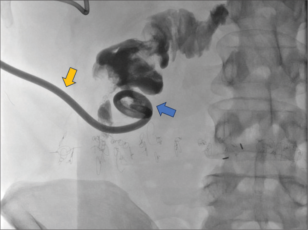 A 60-year-old male with Crohn’s disease who presented with an enterocutaneous fistula. Procedurally obtained digital X-ray fluoroscopic image shows the placement of a self-retaining drainage catheter left in place within a small bowel (blue arrow) through the fistula tract (yellow arrow). Contrast highlights the small bowel lumen.