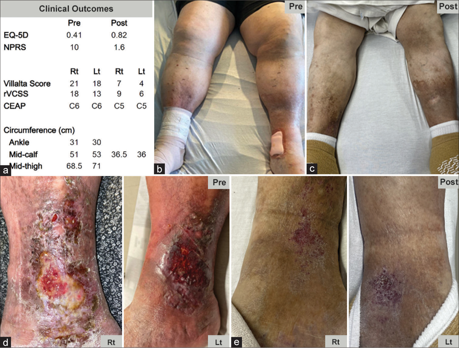 A 60-year-old male with a 25-year history of recurrent venous thromboembolism and 9-year history of recurrent inferior vena cava and left common femoral vein in-stent thrombosis presented with worsening lower extremity swelling and bilateral non-healing ulcers. The patient was treated with the RevCore mechanical in-stent thrombectomy device. (a) Significant clinical improvements were seen at 4- and 8-week post-procedure. (b and c) Significant preprocedural swelling in the feet and calves is resolved by 8-week post-procedure. (d and e) Healing of multiple ulcers was observed 8-week post-procedures. (EQ-5D: EuroQoL 5 dimension, NPRS: numeric pain rating scale, rVCSS: revised venous clinical severity score, CEAP: Clinical etiology anatomy pathophysiology, Rt: right, Lt: left).