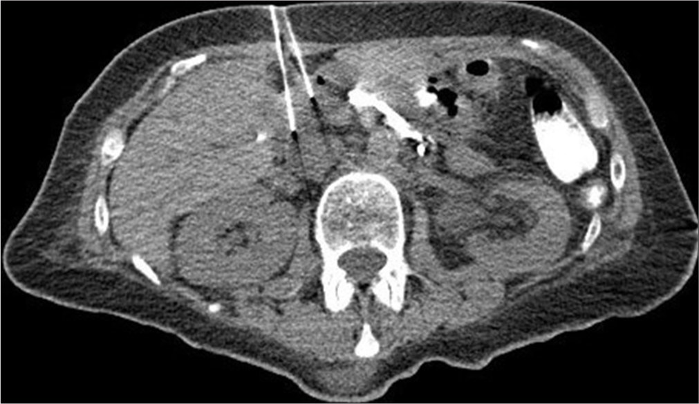 A 65-year-old female with esophageal perforation and a remote history of gastric bypass requiring enteral access for feeding. Non-contrast-enhanced intraprocedural computed tomography of the upper abdomen. Two 22-gauge needles were used to access the duodenal bulb, which was distended with fluid and air. The medial needle was used to pin the mobile duodenum, and the lateral needle was used to access the duodenal lumen.