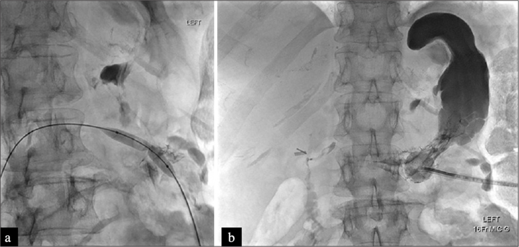 A 65-year-old female with esophageal perforation and a remote history of gastric bypass requiring enteral access for feeding. (a) Fluoroscopic image demonstrates the over-the-wire coaxial balloon angioplasty technique for gastropexy and subsequent percutaneous gastrostomy tube placement. (b) Final fluoroscopic image demonstrates gastrostomy tube position in the gastric remnant.